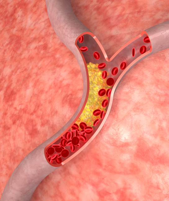 arterial plaque